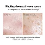Visual Blackhead Vacuum with Camera – 20X Magnification & 6 Suction Levels - Image 4